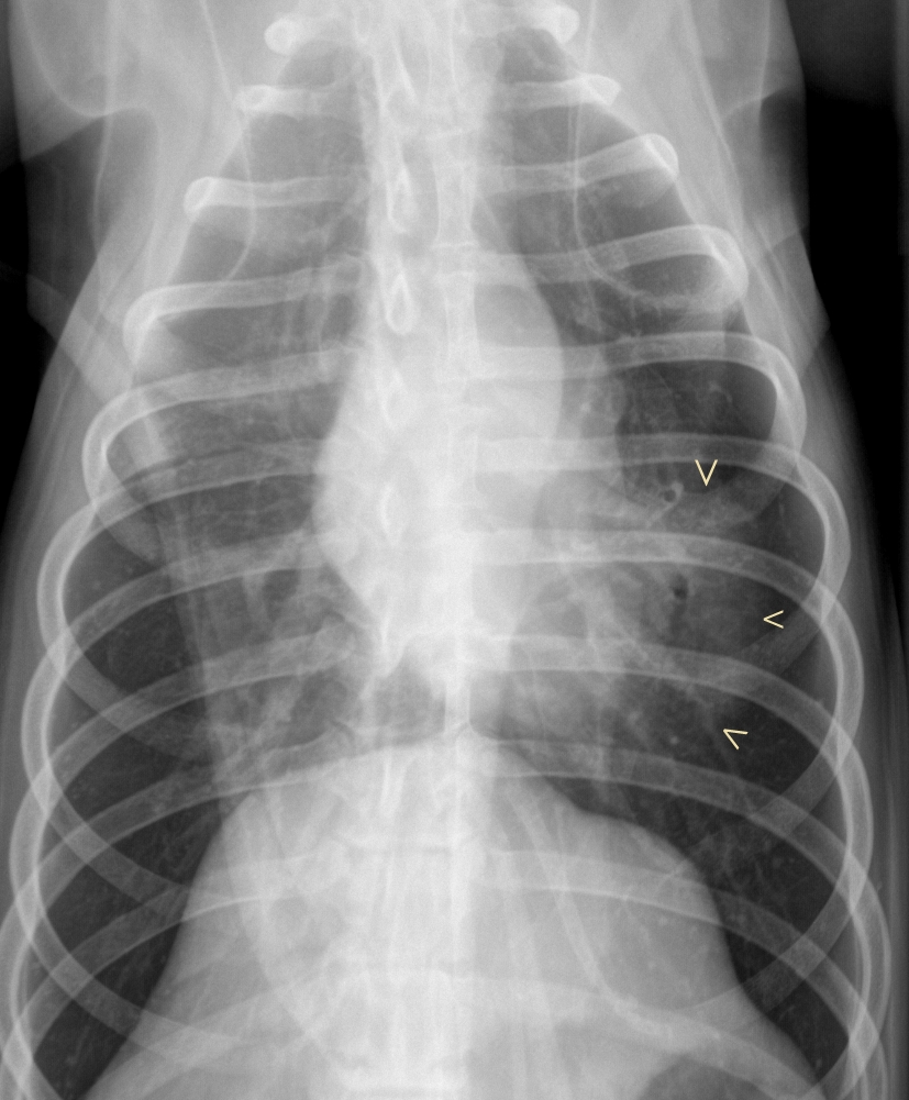 DV chest rad with pneumonia