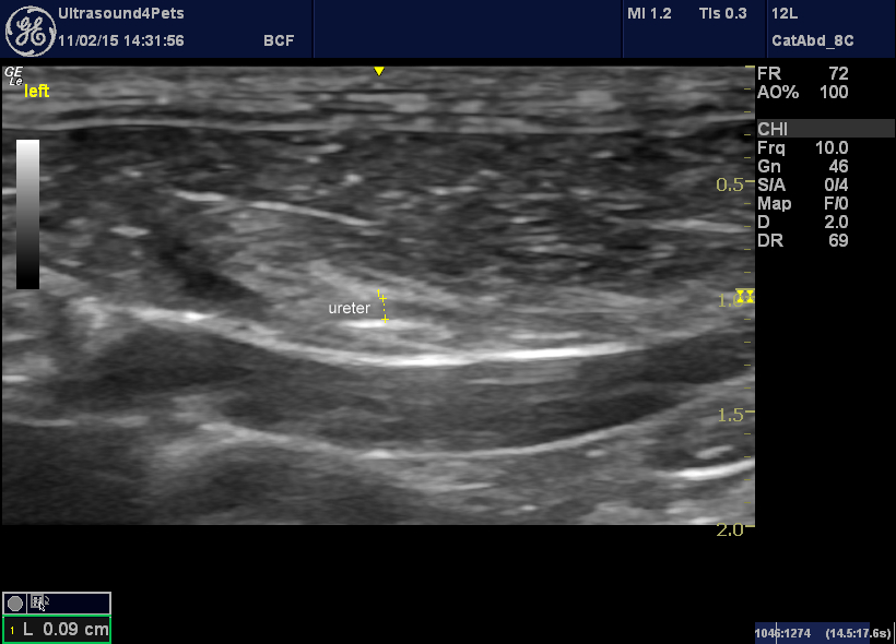 L ureter middle section