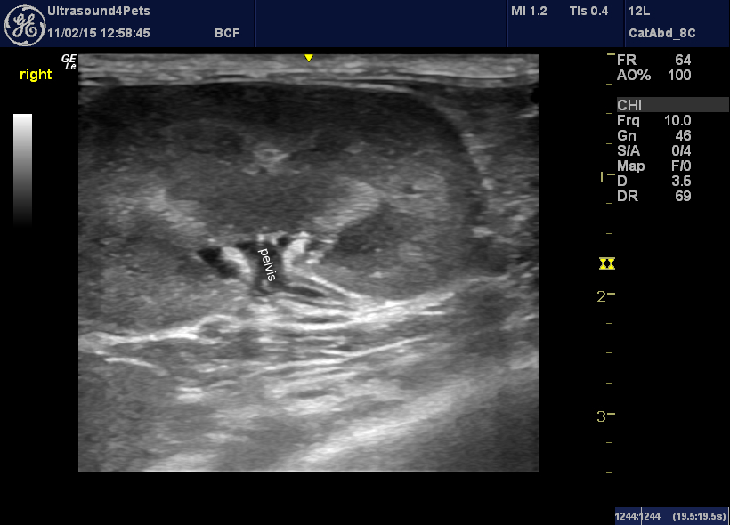 R kidney and proximal ureter
