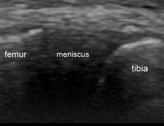 meniscus 1