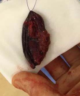 The offending gallbladder after removal.