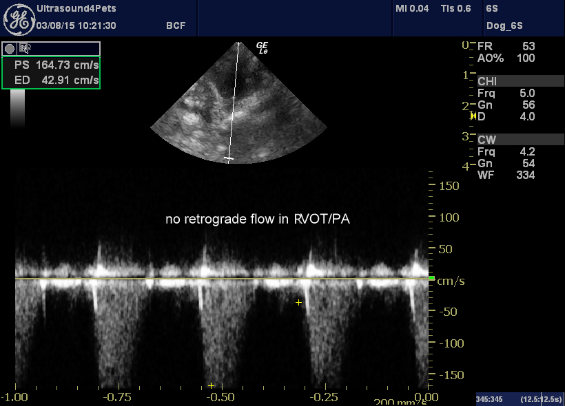 Right transverse view at the level of the pulmonary artery with CW Doppler