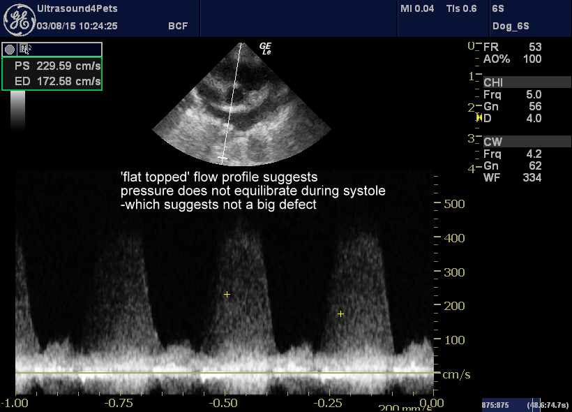 the same view with PW Doppler interrogation of flow through the VSD
